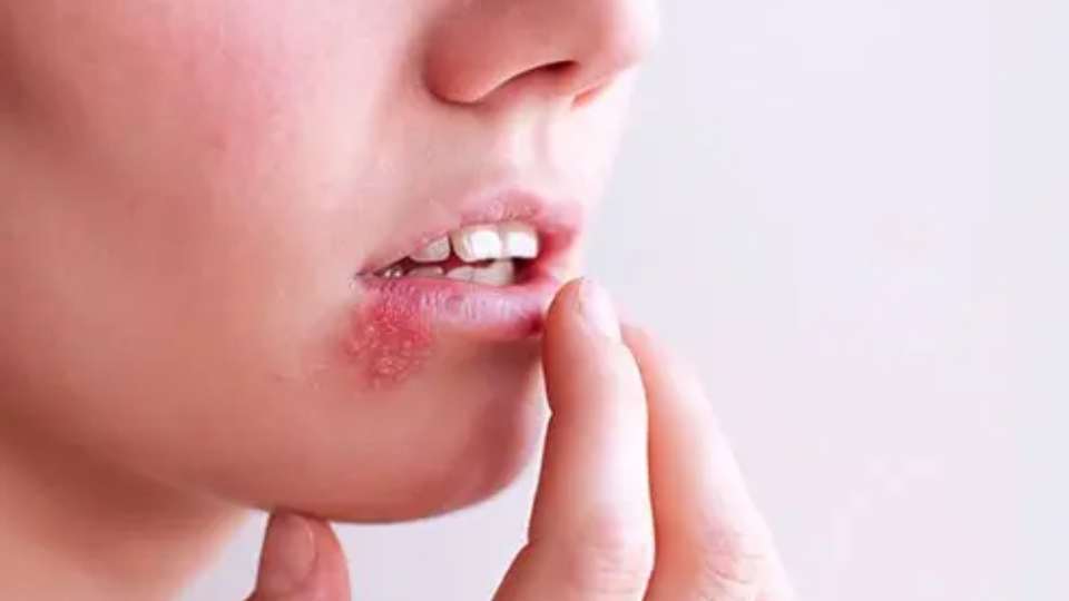 Epstein-Barr (EBV) - virus mononucleosi