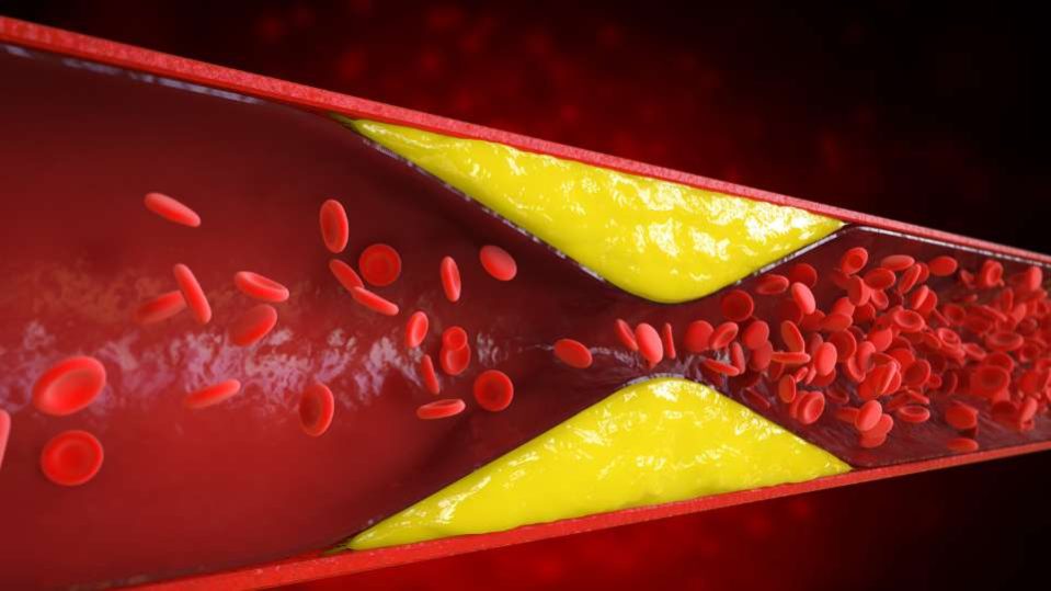 Ipercolesterolemia familiare - cos’è, come si trasmette e rischi per il cuore